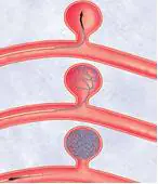 Illustration showing the progression of a brain aneurysm, from early stages to rupture.