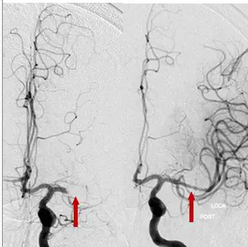 Before and after images of a neurovascular procedure, showing angiogram results with labeled areas.