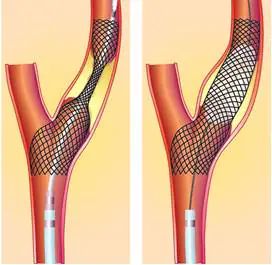 Illustration of a brain aneurysm being treated with a stent, showing before and after images of the procedure.