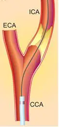 Illustration of a carotid artery with a catheter inserted, showing the ICA, ECA, and CCA.