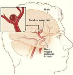 Illustration of a cerebral aneurysm in the brain with labeled blood vessels.
