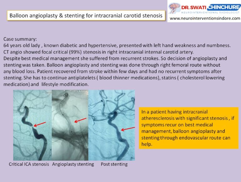 Stenting Iih Intracranial stenosis- intracranial stenting - Swati-Chinchure