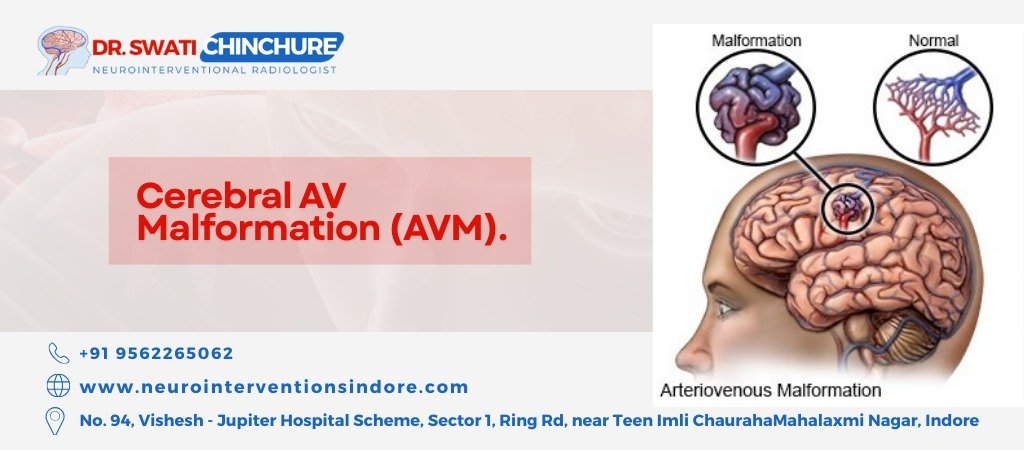 "Dr. Swati Chinchure, Neurointerventional Radiologist, explaining cerebral arteriovenous malformation (AVM) with contact details and hospital address in Indore."