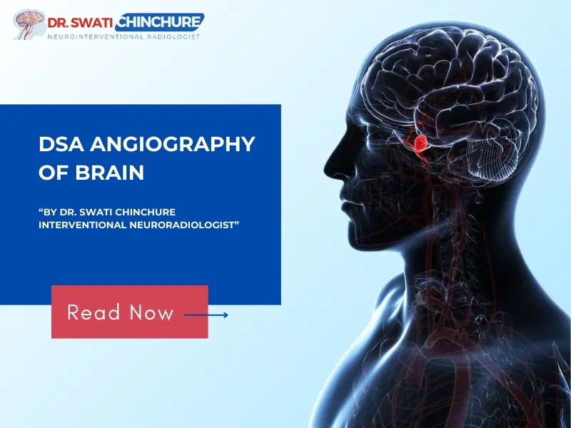 DSA angiography of brain by Dr. Swati Chinchure, Interventional Neuroradiologist