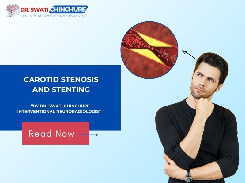 Illustration showing carotid artery narrowing and carotid stenting procedure explained by a specialist