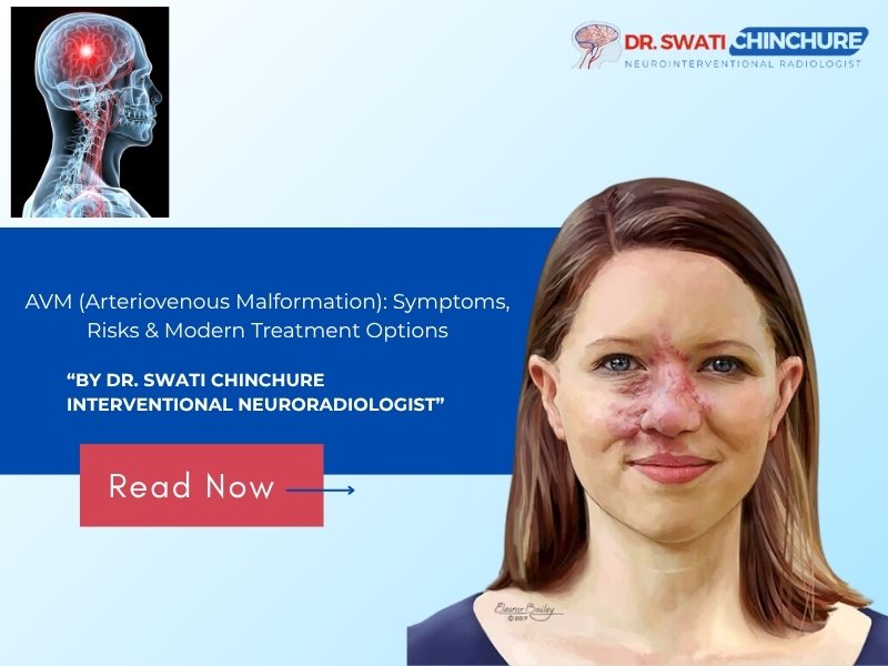 Illustration for AVM (Arteriovenous Malformation) symptoms, risks, and modern treatment options by Dr. Swati Chinchure, Interventional Neuroradiologist in Indore.