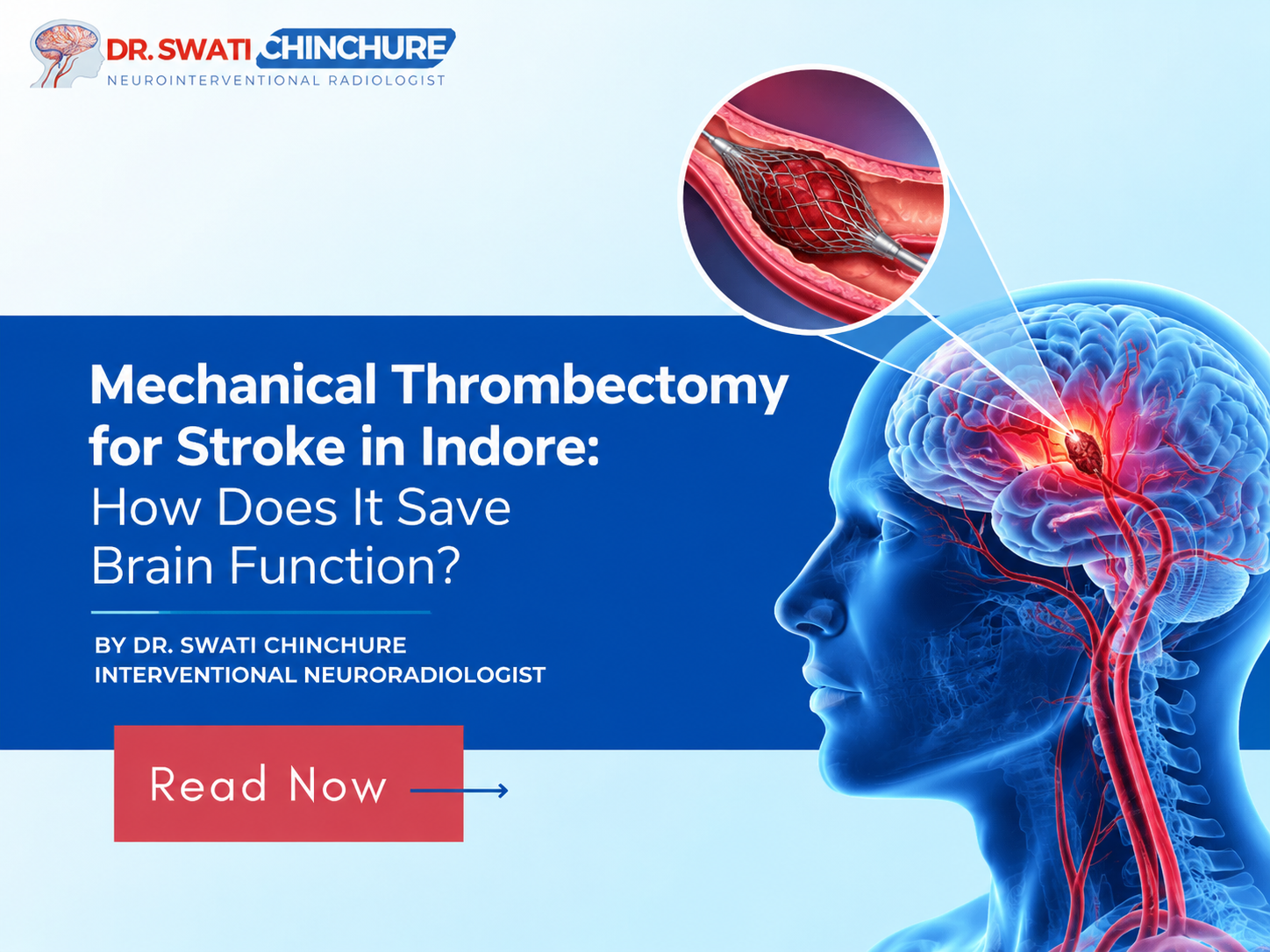 Mechanical thrombectomy for stroke in Indore showing how clot removal helps restore brain blood flow
